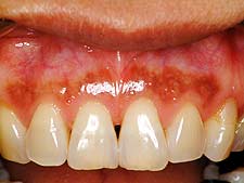 歯科　レーザー治療症例